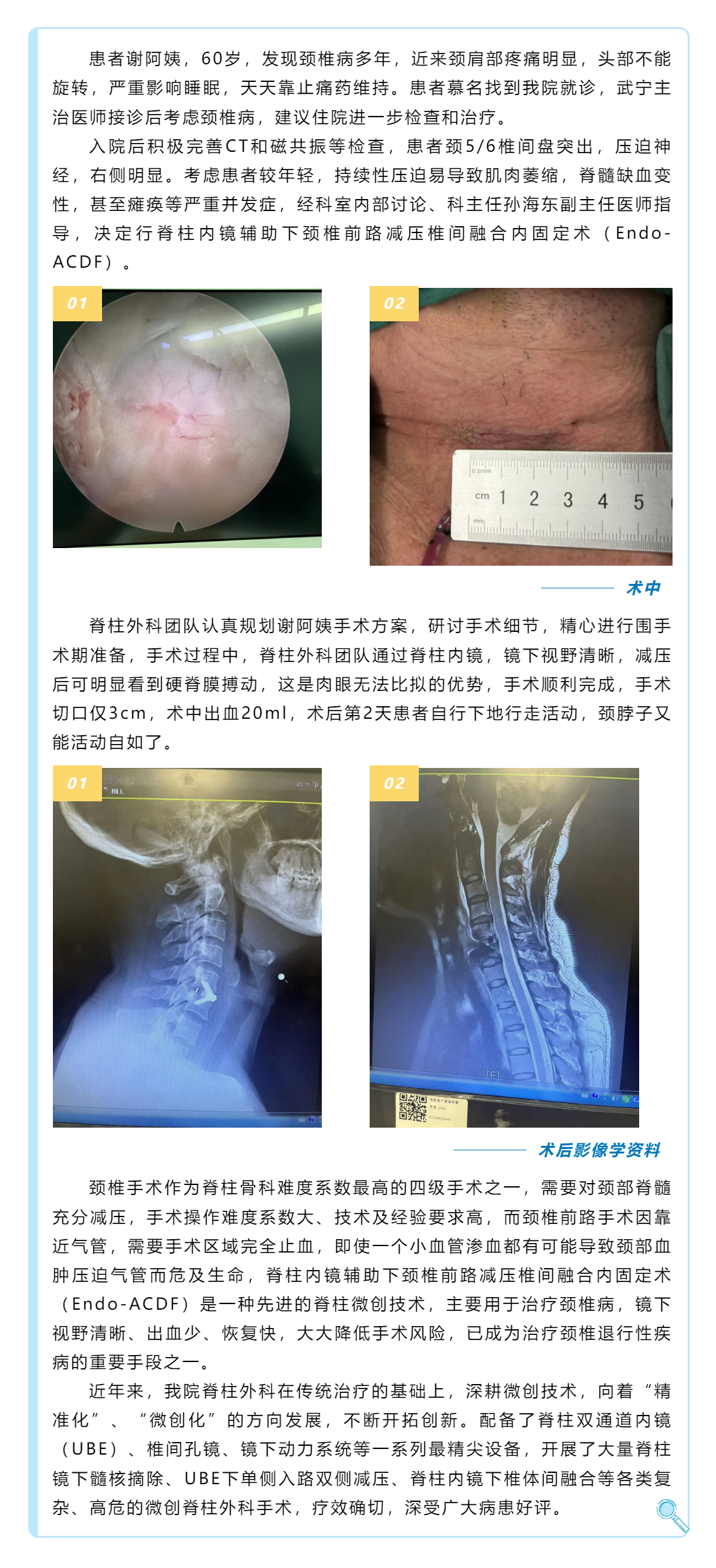 頸椎退行性疾病患者福音——頸椎前路減壓椎間融合內(nèi)固定術(shù).png