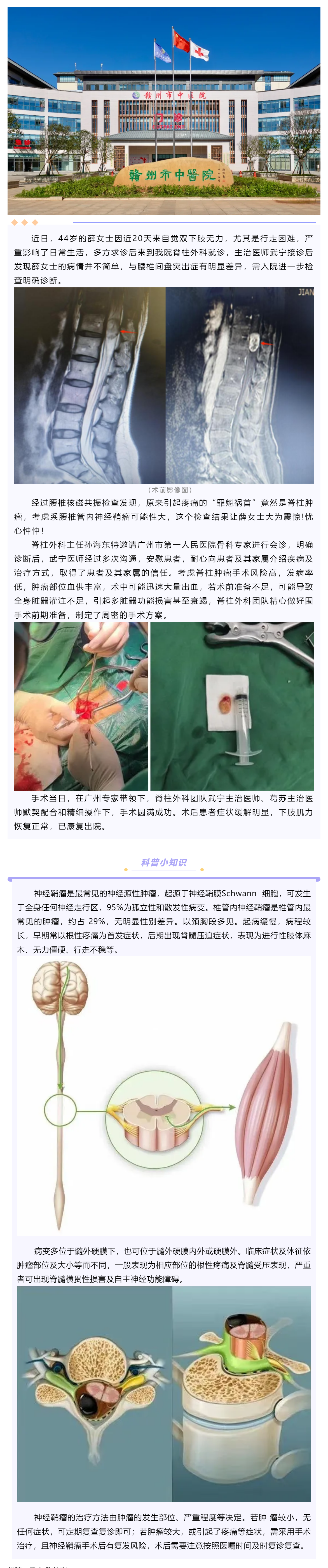 腰腿痛、下肢乏力麻木，提防神經鞘瘤！.png